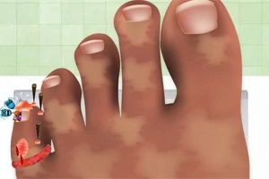 Stopa z zaniedbanymi paznokciami i otarciami na palcach, z wbitymi gwoździami w mały palec